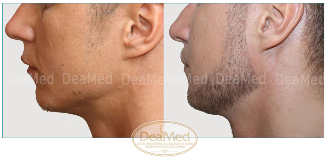BEARD HAIR TRANSPLANTATION BHT