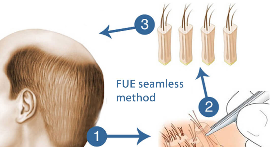 FUE HAIR TRANSPLANTATION