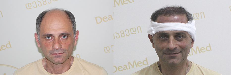 LONG HAIR TRANSPLANTATION CLINIC