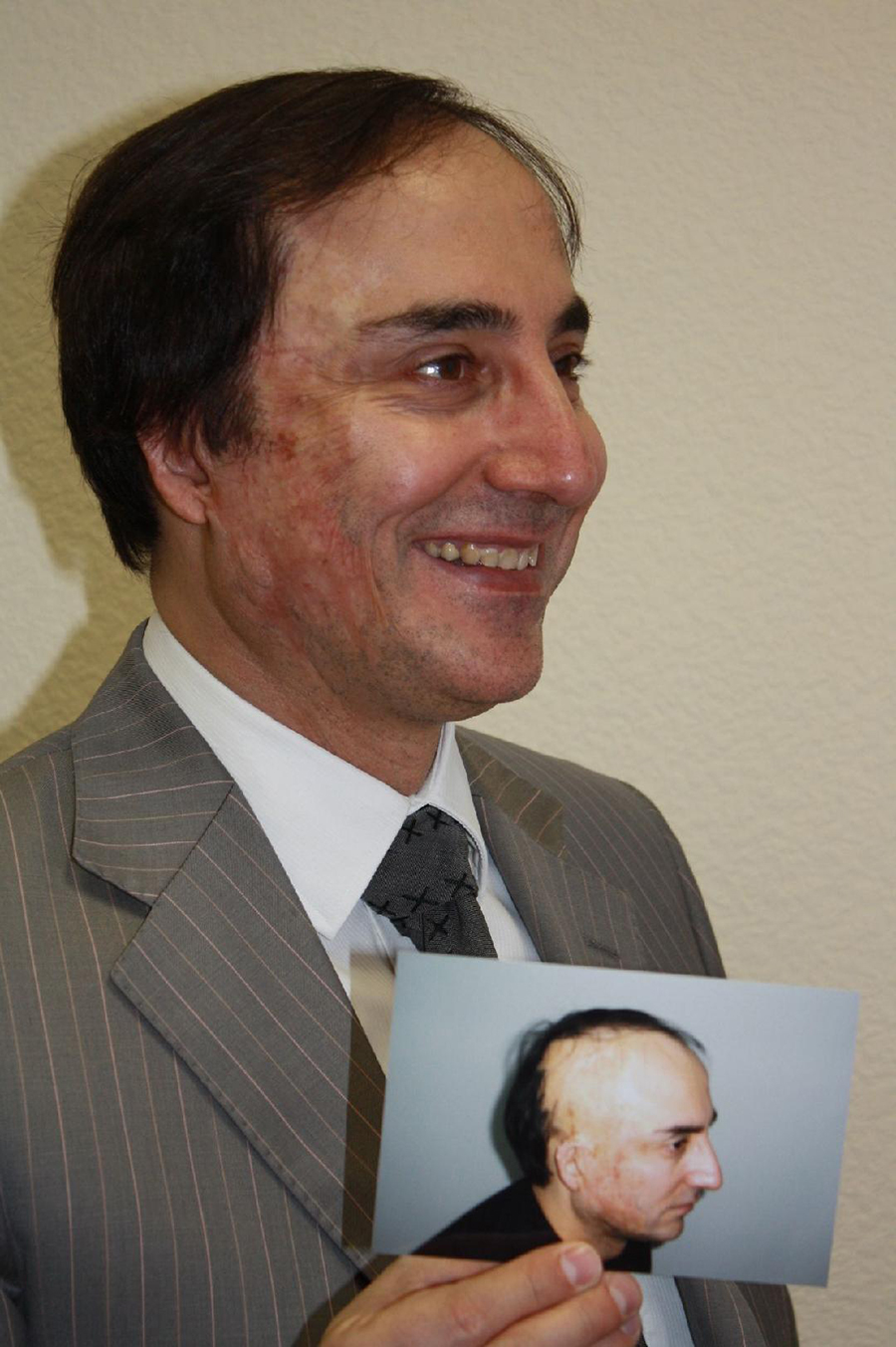 HAIR TRANSPLANTATION IN SCARS and BURNS