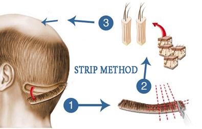 STRIP HAIR TRANSPLANTATION